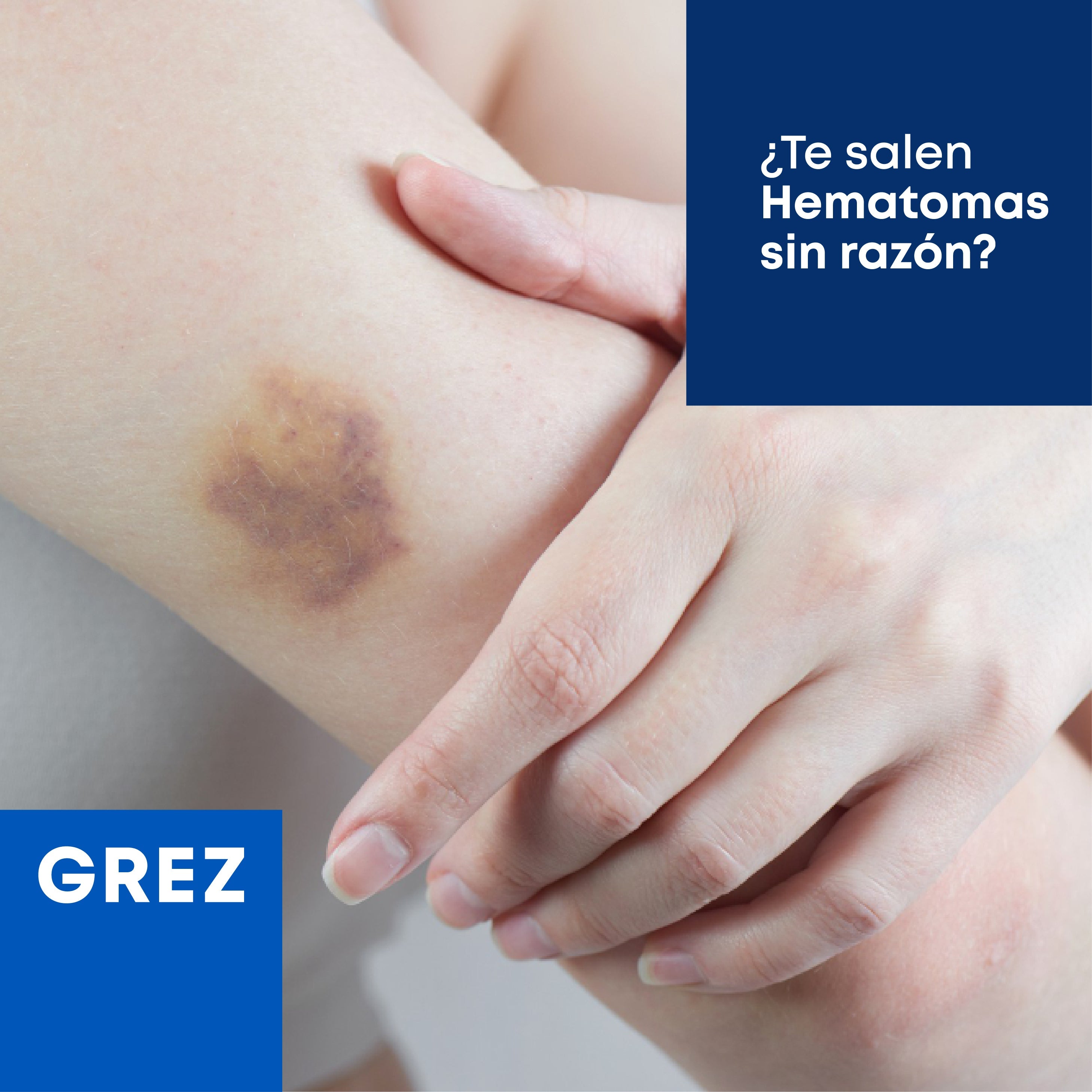 ¿TE SALEN HEMATOMAS SIN RAZÓN?