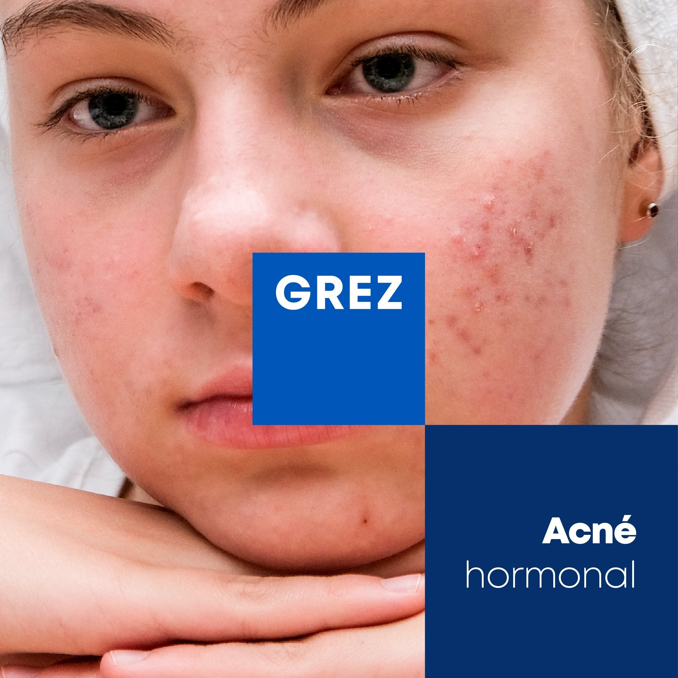 Acné hormonal